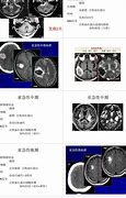 制定全面健康计划以应对脑血管硬化的症状