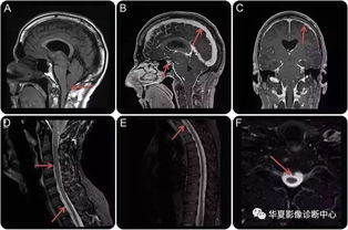 全前脑畸形孩子图片