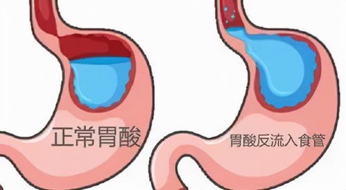 反流性食管炎不容忽视的消化系统症状