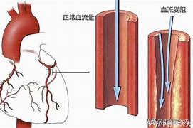 冠心病早期症状在工作环境中的识别与应对策略