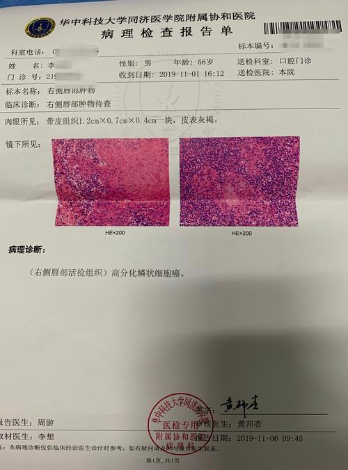 高分化鳞癌是什么意思