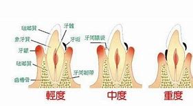 牙周炎偏方很有效