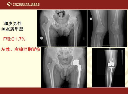 一、患者生命质量的提升