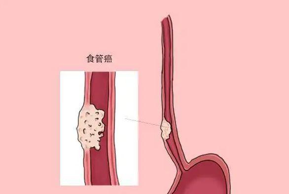 食道癌症状表现